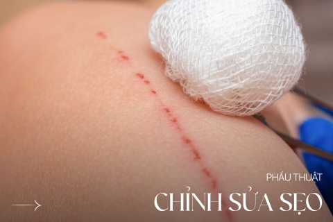 Phẫu thuật chỉnh sửa sẹo